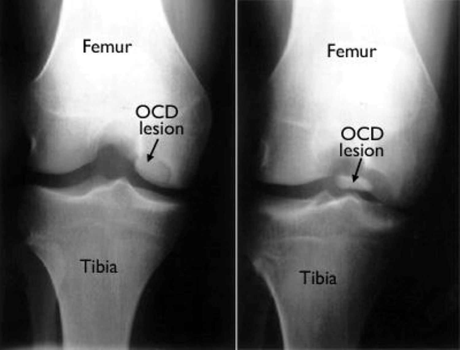 osteochondritis dissecans knee