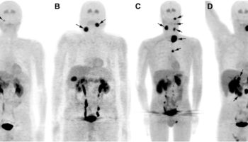 paraganglioma tumor