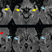 paraneoplastic limbic encephalitis