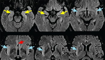 paraneoplastic limbic encephalitis