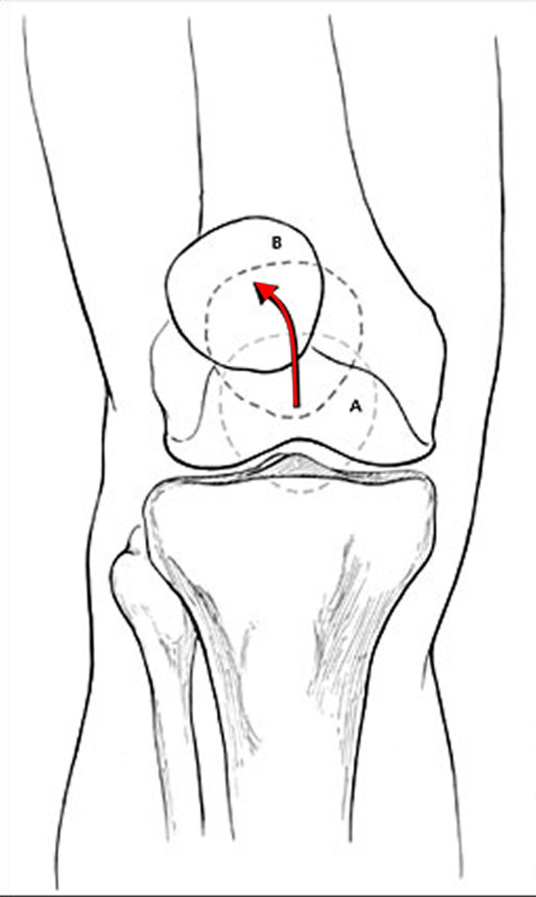 Patellofemoral Pain Syndrome - Causes, Symptoms, Treatment