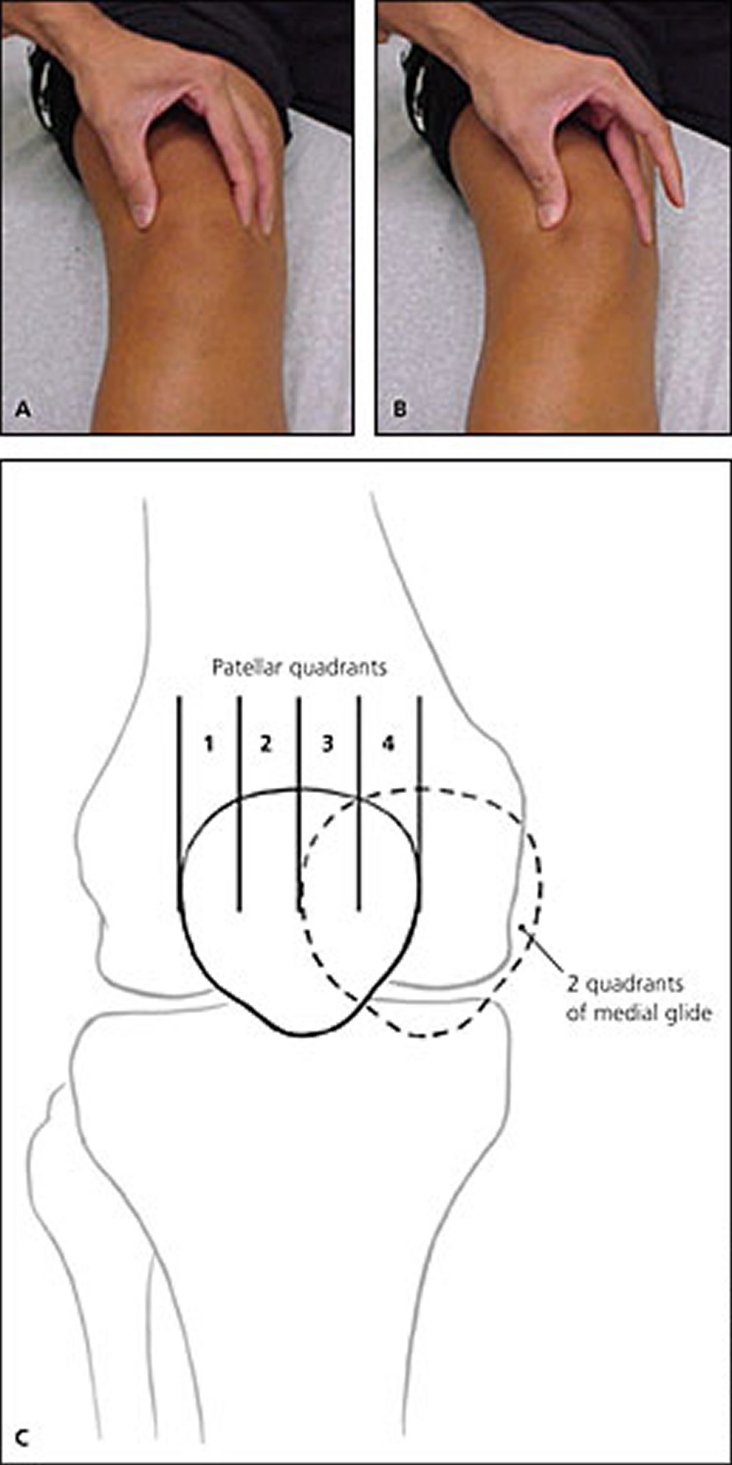 patellofemoral pain syndrome - patellar glide test