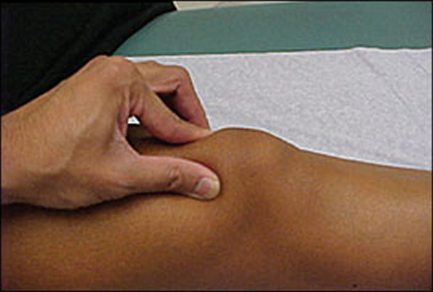 patellofemoral pain syndrome - patellar grind test
