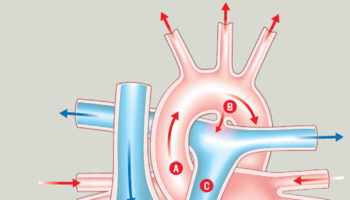 patent ductus arteriosus