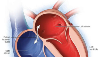 patent foramen ovale