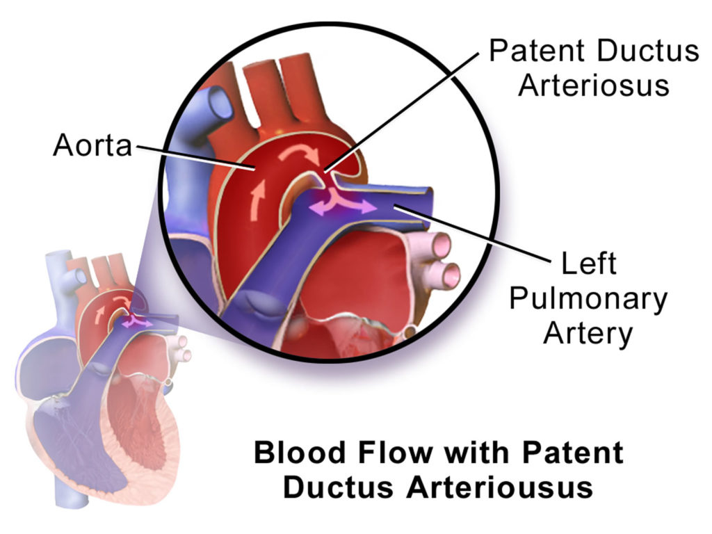 Patent Ductus Arteriosus Causes, Symptoms, Diagnosis, Treatment