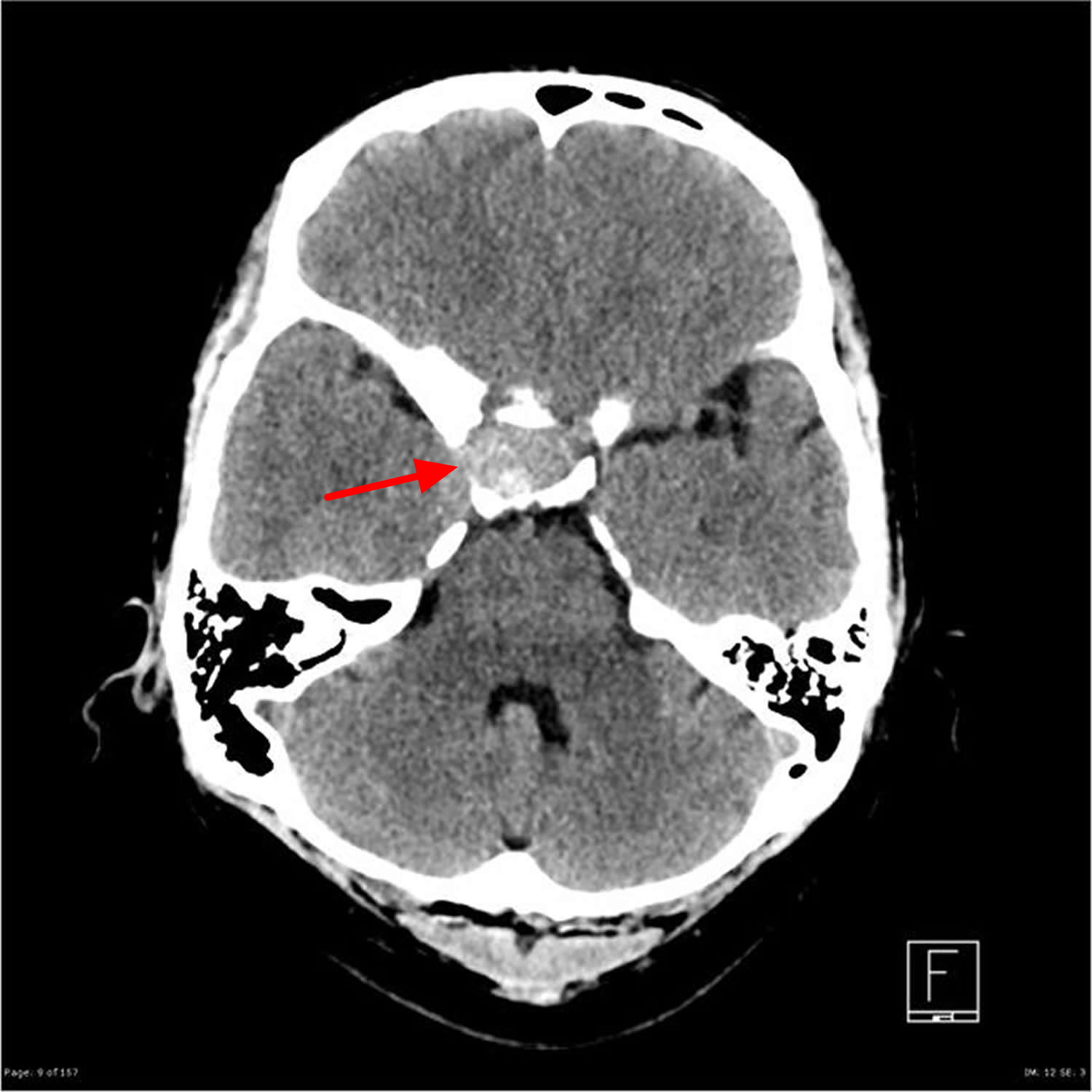 Can A Pituitary Tumors Cause Vertigo