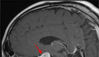 pituitary tumor MRI