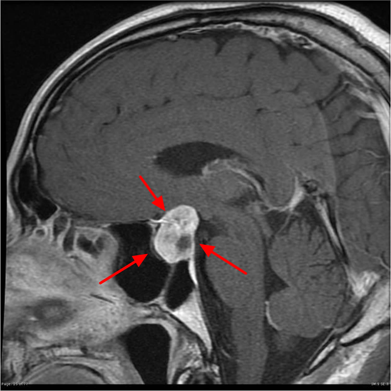 Pituitary Tumor Signs Symptoms Diagnosis MRI Surgery Treatment