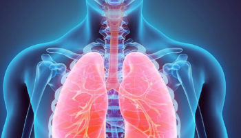 pleurisy