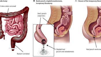 pouchitis