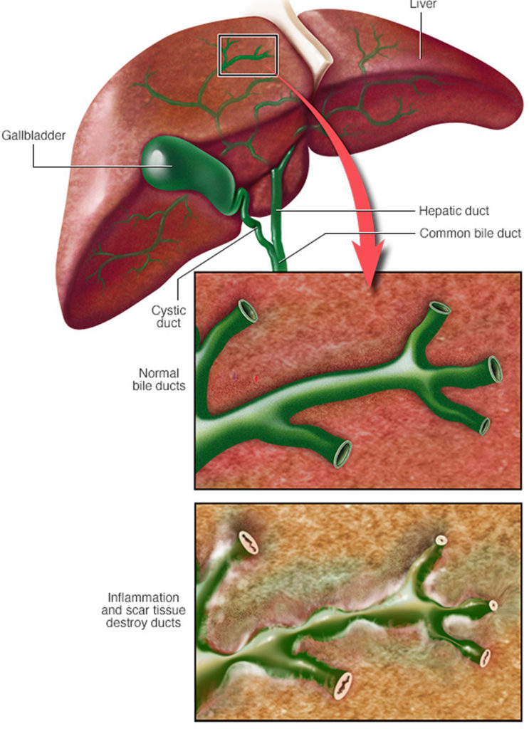 Primary Sclerosing Cholangitis Causes, Symptoms, Prognosis, Treatment