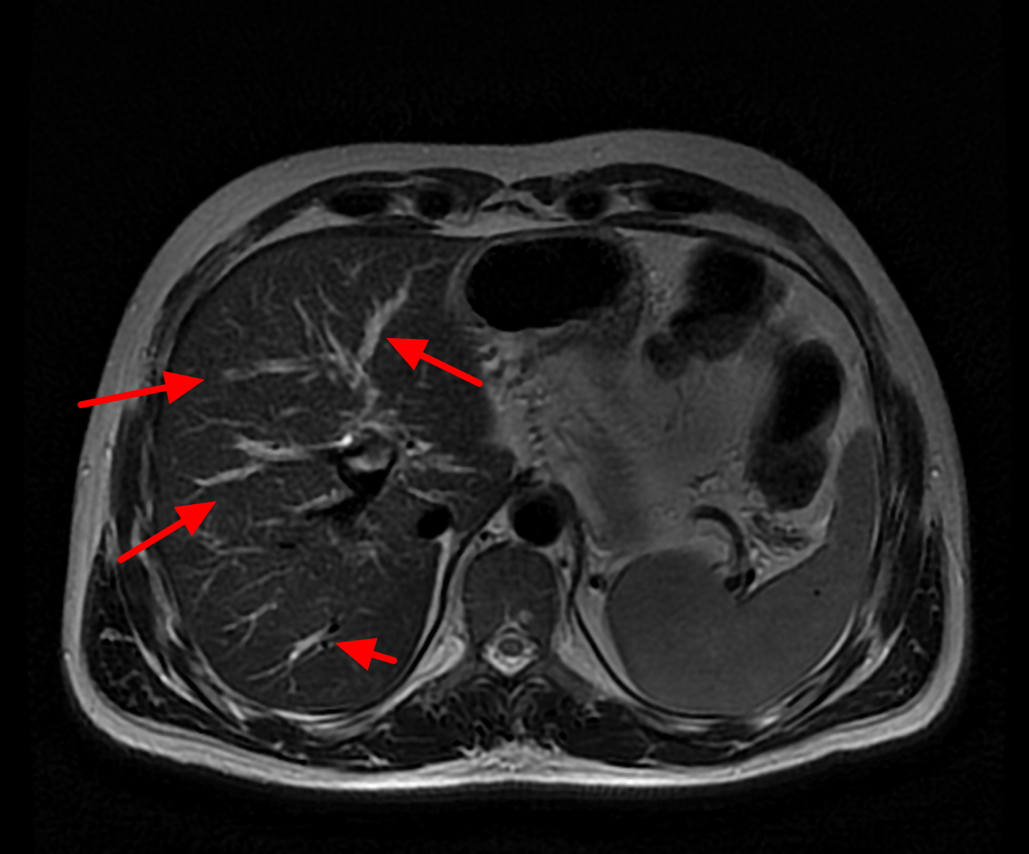 primary sclerosing cholangitis - MRI