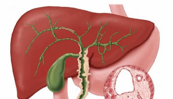 primary_sclerosing_cholangitis