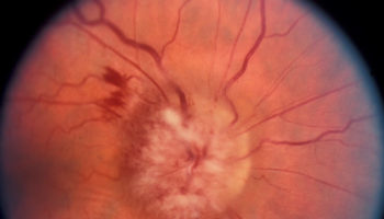 pseudotumor cerebri