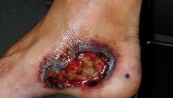 pyoderma gangrenosum