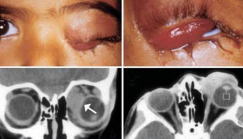 rhabdomyosarcoma