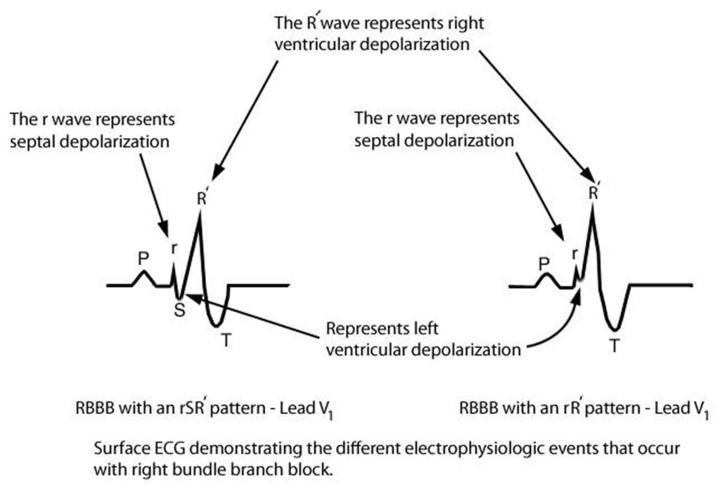 Bundle Branch Block - Causes, Symptoms, Diagnosis, Treatment