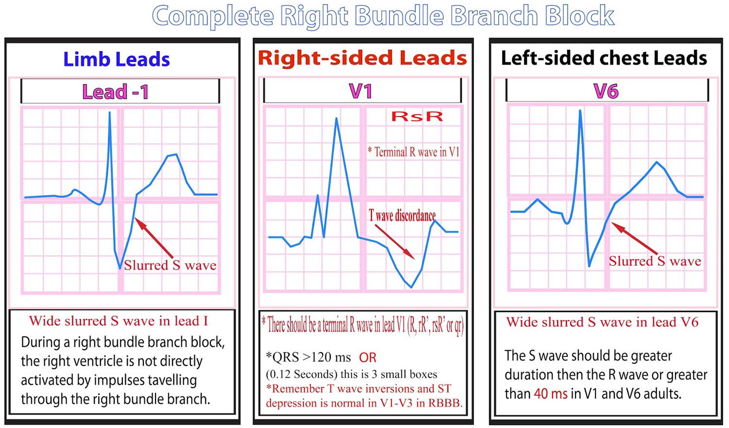 Types Of Blocks Ecg at Tracy Ness blog