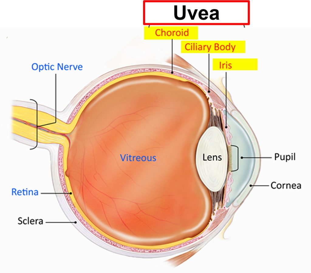 Iritis, Traumatic Iritis- Causes, Symptoms, Signs, Diagnosis, Treatment