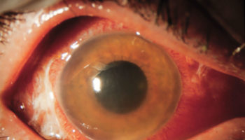 uveitis