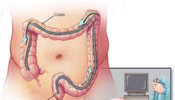 colonoscopy