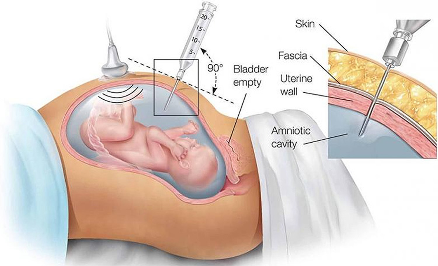Amniocentesis Test Accuracy, Risks, Complications