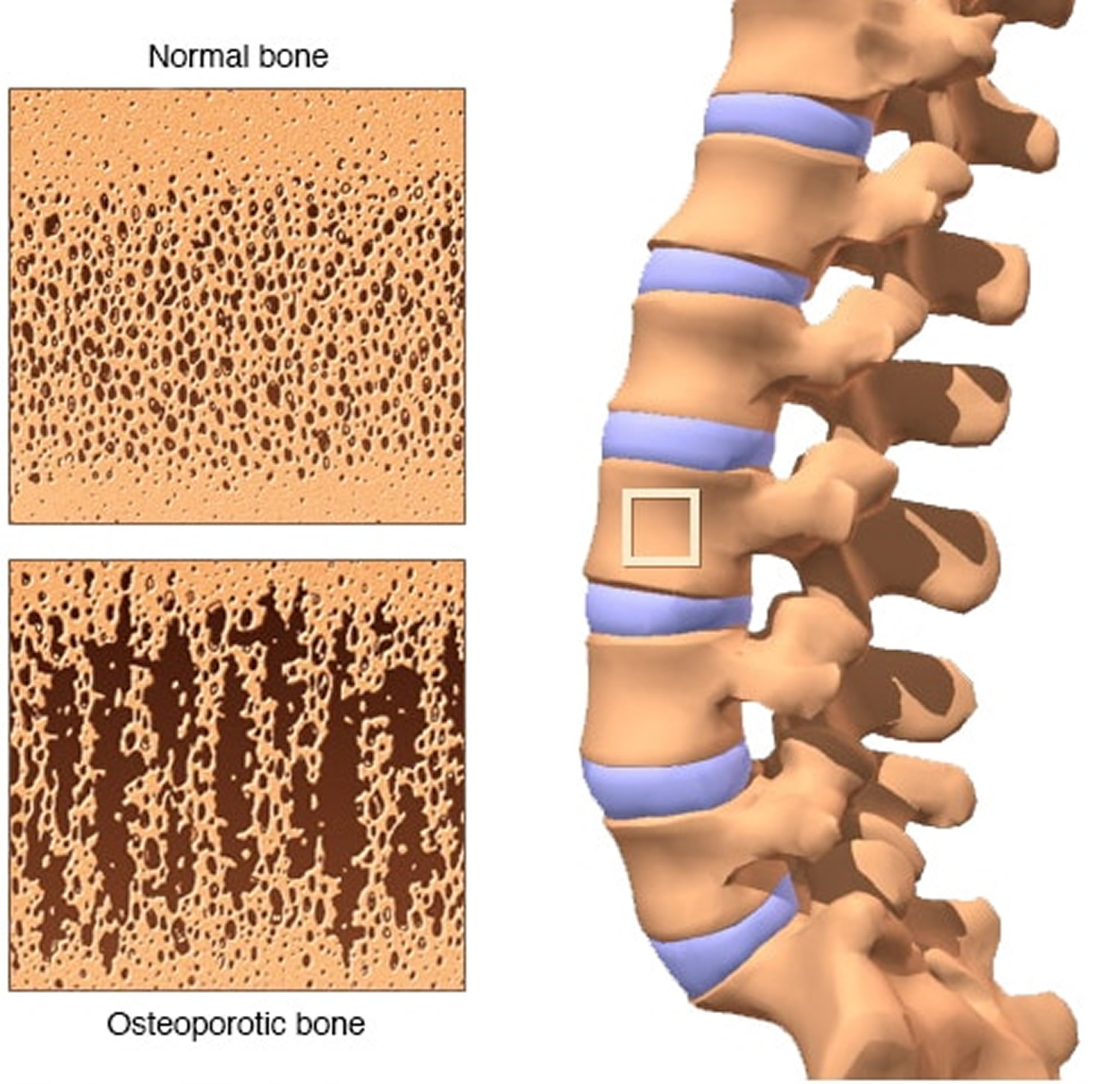 bone density test results