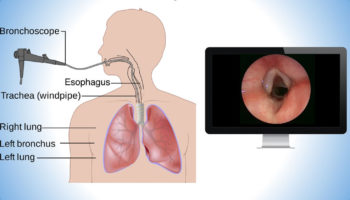 Brochoscopy