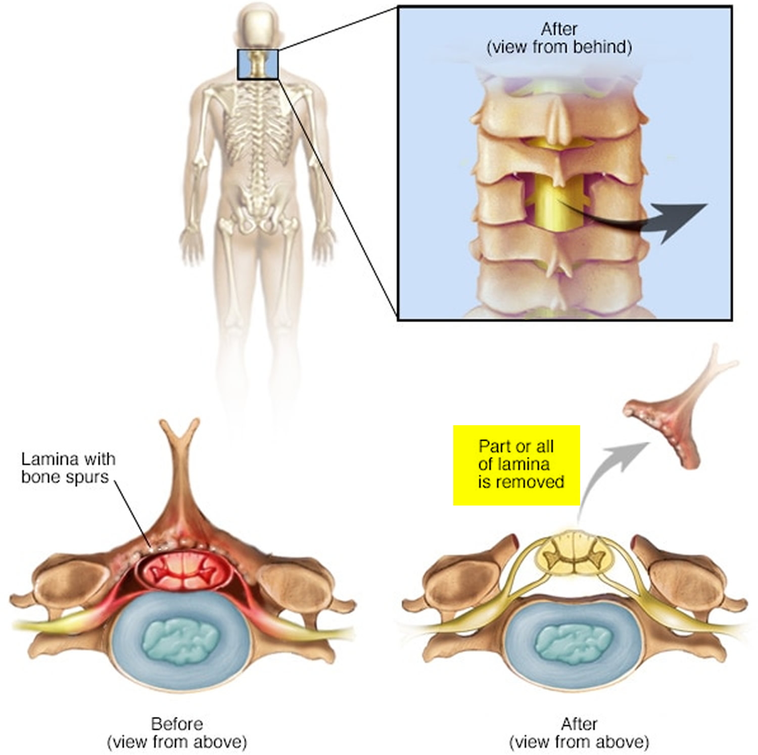 Does bone grow back after laminectomy?