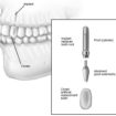 dental-implant-surgery