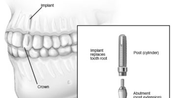 dental-implant-surgery