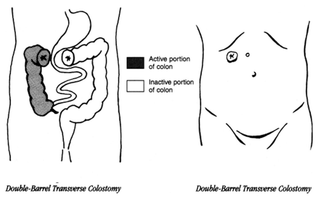 Colostomy How To Change A Colostomy Bag & Living With It
