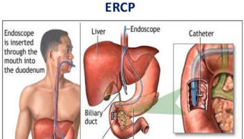 ERCP – Endoscopic retrograde cholangiopancreatography