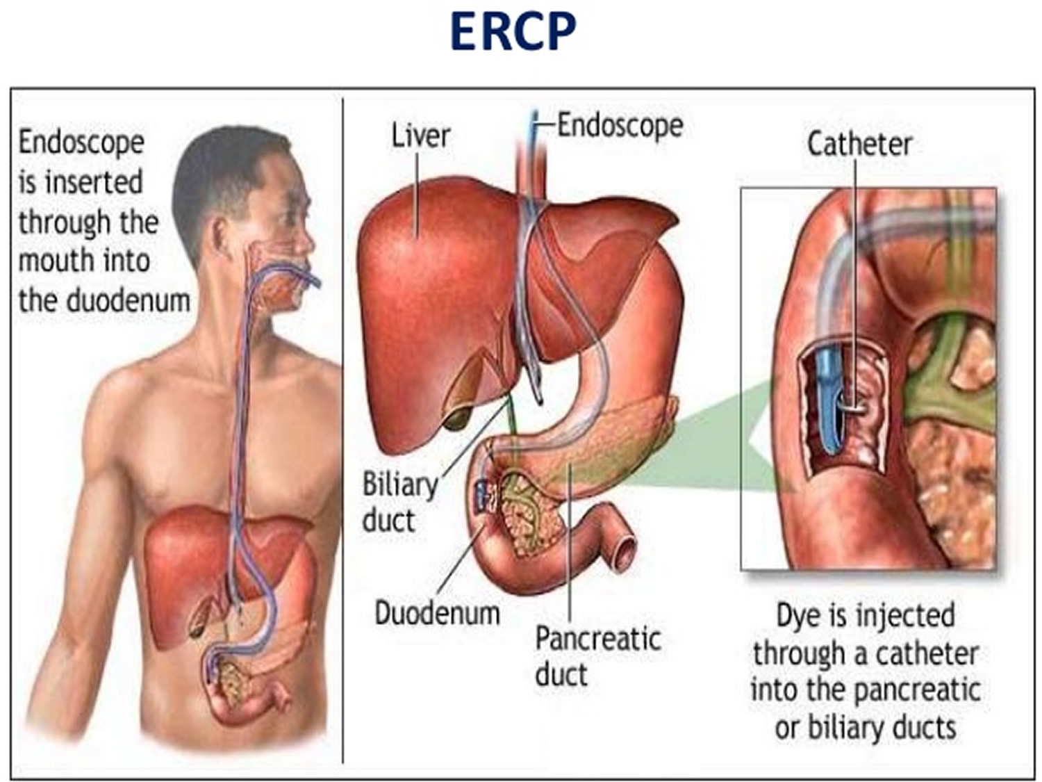 ERCP Procedure - Indications, Recovery, Complications