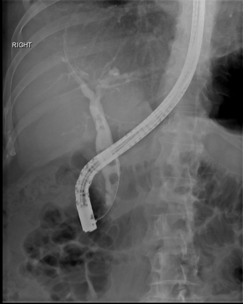 ERCP Procedure - Indications, Recovery, Complications