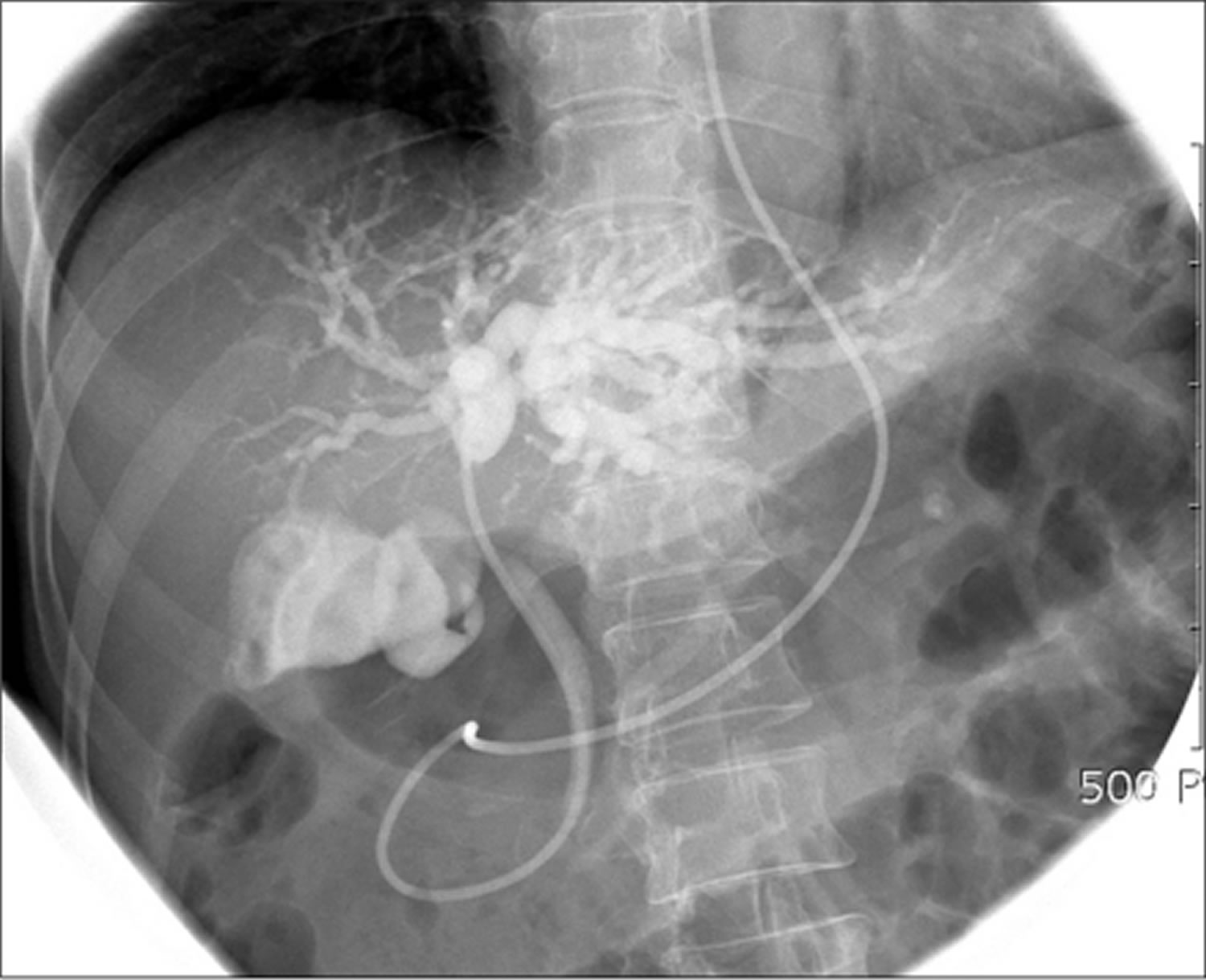 ERCP Procedure - Indications, Recovery, Complications