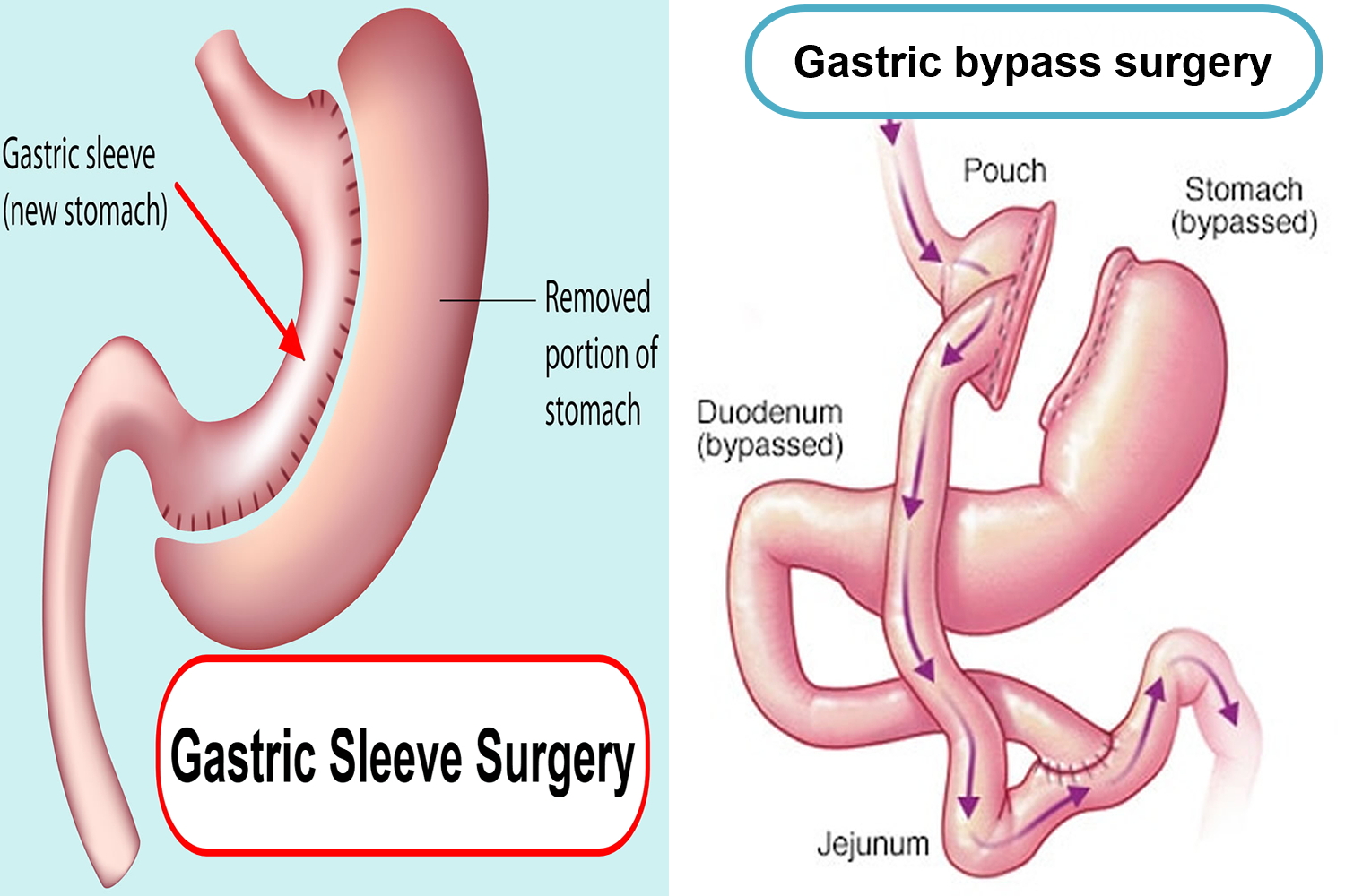 Gastric sleeve surgery indications risks complications