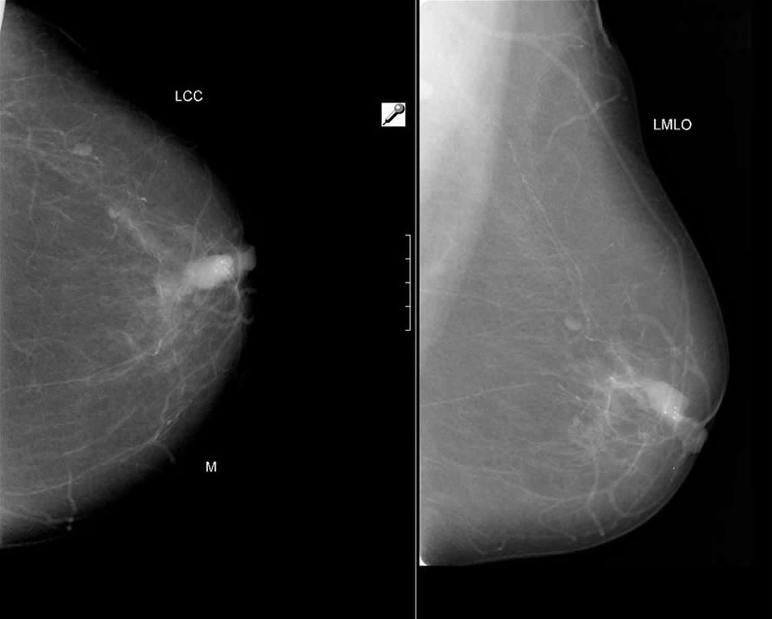 Intraductal carcinoma of the breast