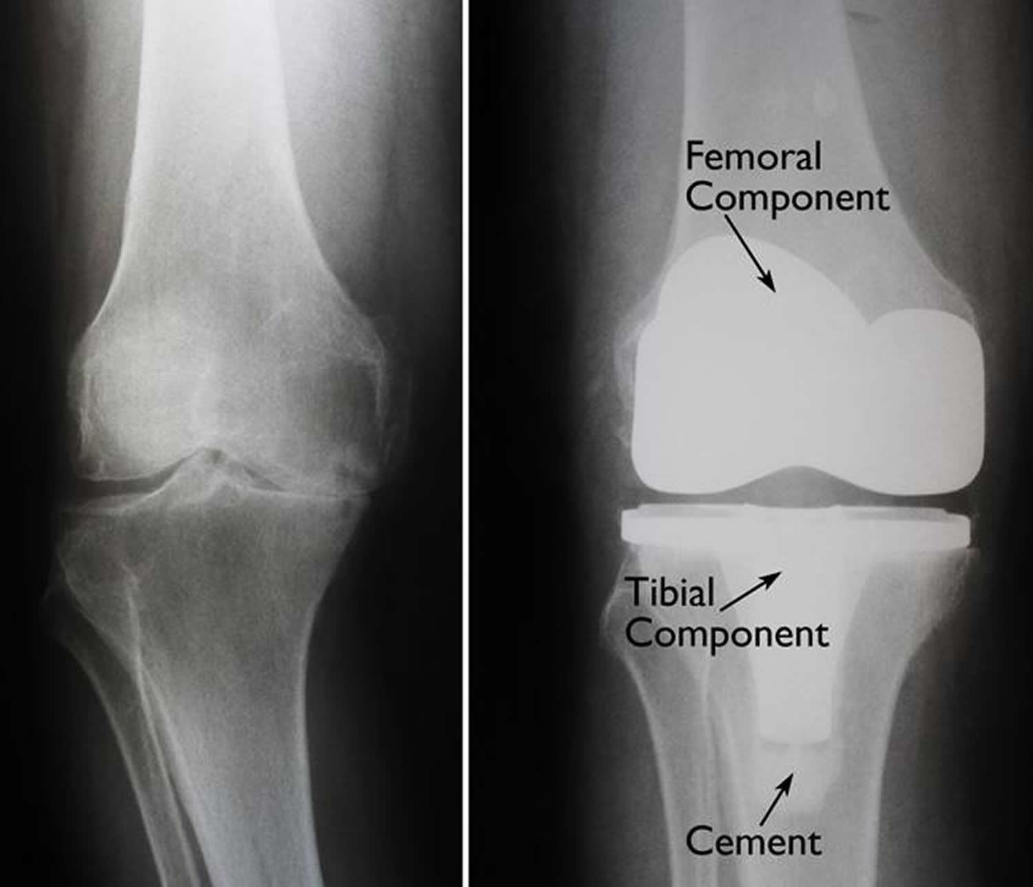 Knee replacement surgery before and after