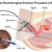 LEEP Procedure