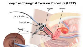 LEEP Procedure