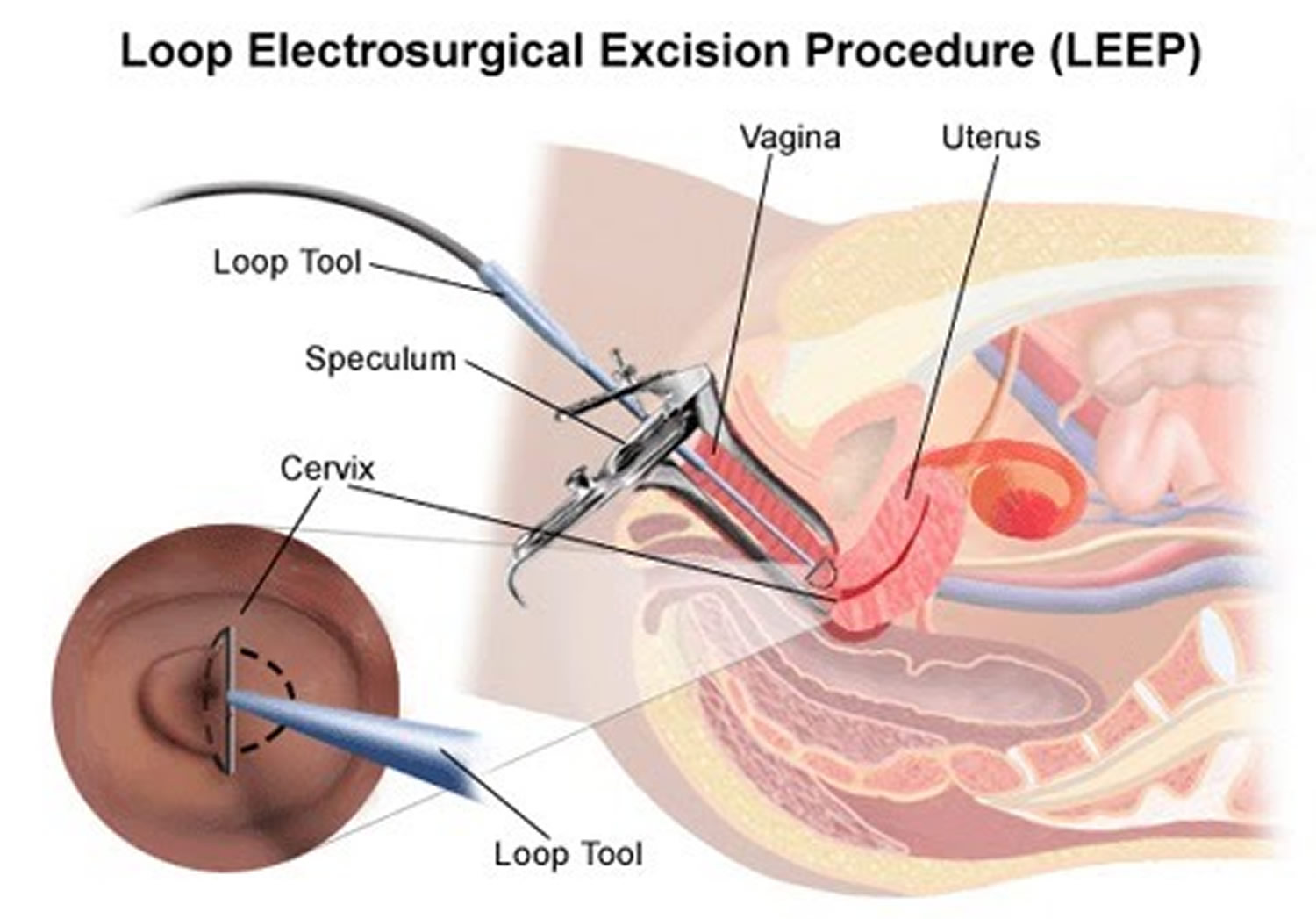 human papillomavirus infection loop electrosurgical excision procedure)