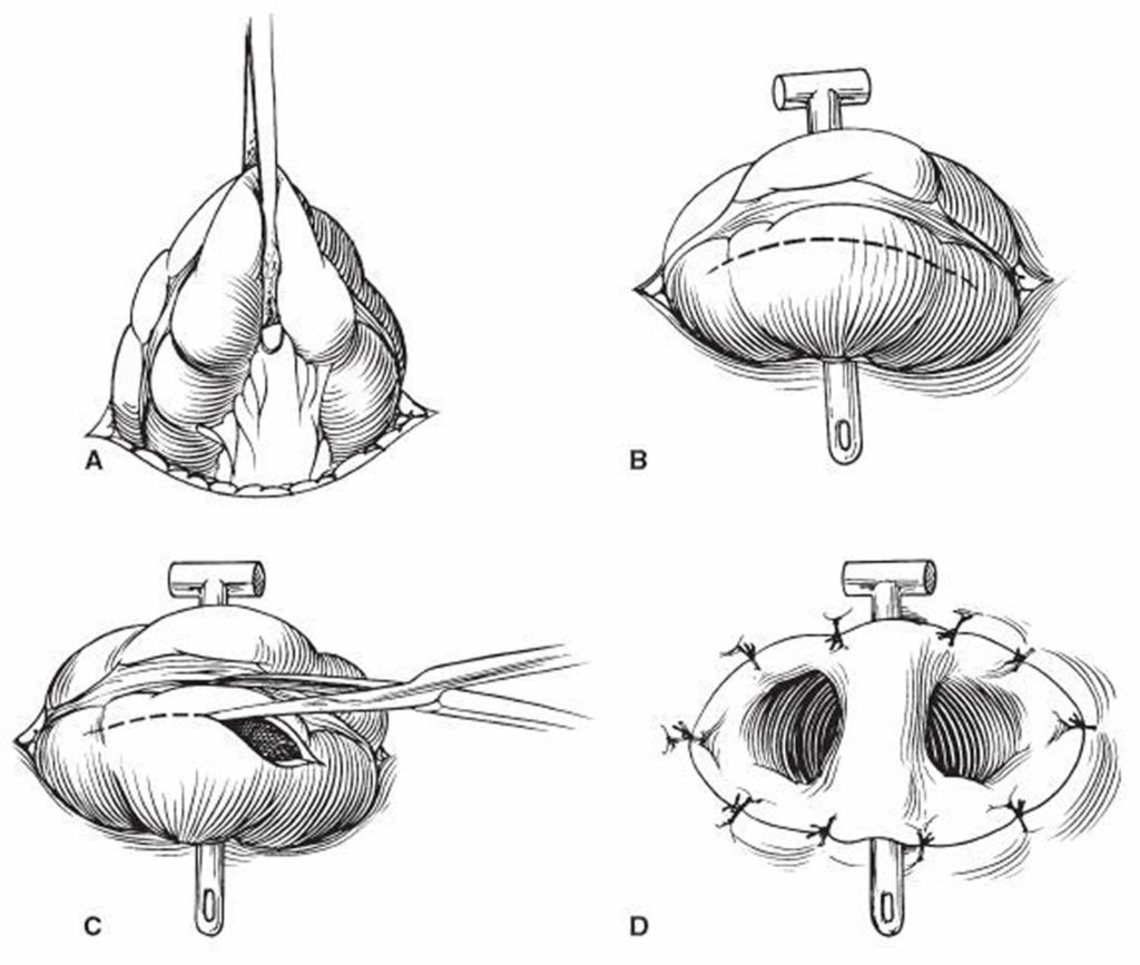 Colostomy How To Change A Colostomy Bag & Living With It