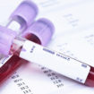 MCV blood test