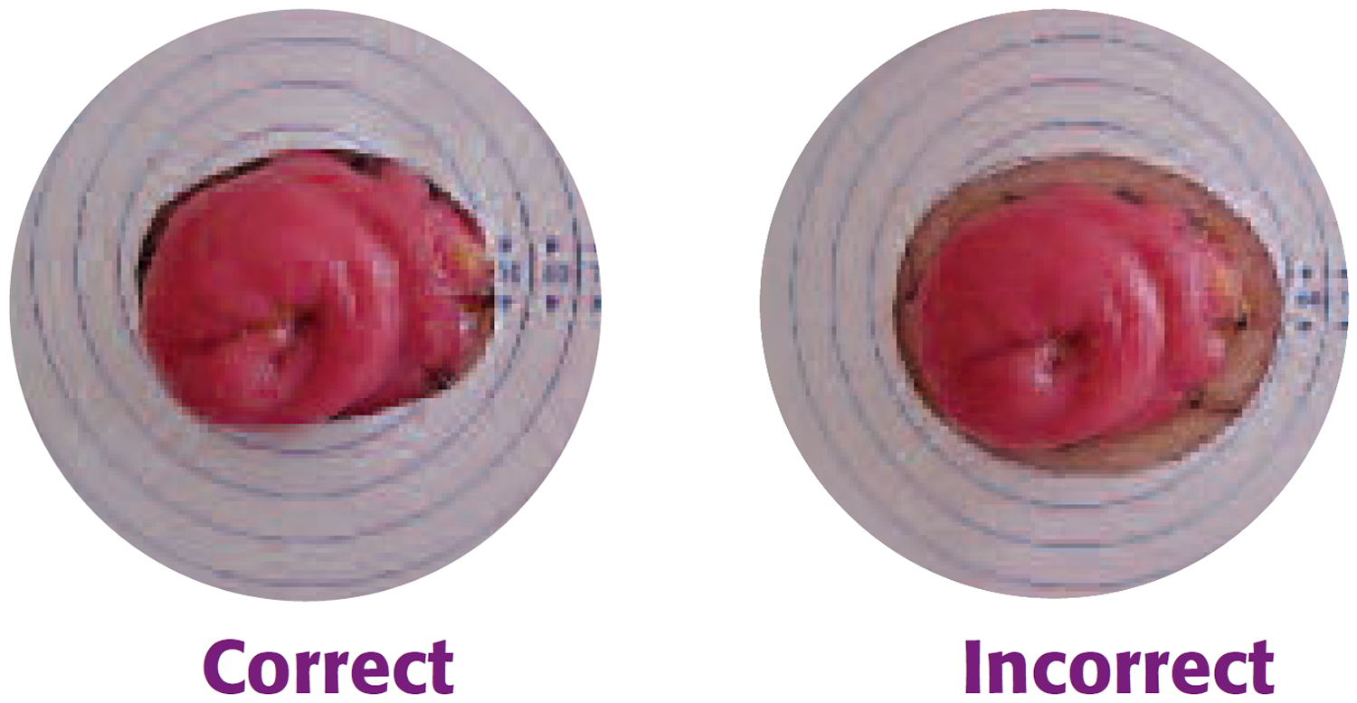 Colostomy - How To Change A Colostomy Bag & Living With It