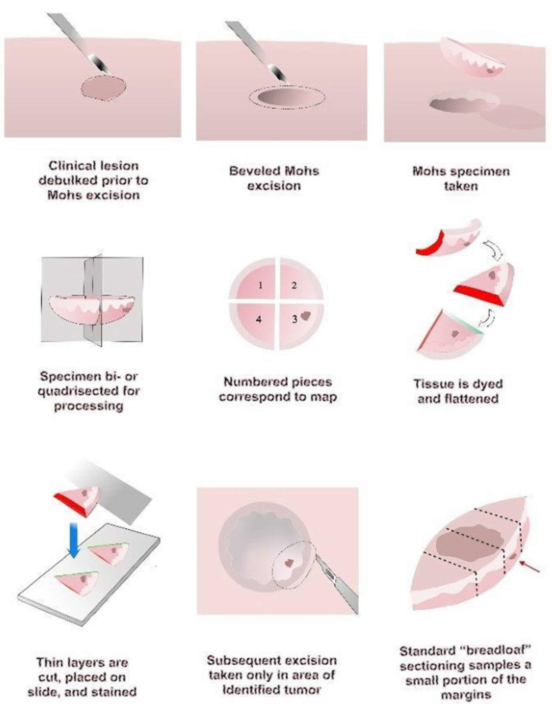 mohs-micrographic-surgery-skin-cancer-advantages-complications