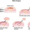 Mohs surgery