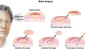 Mohs surgery