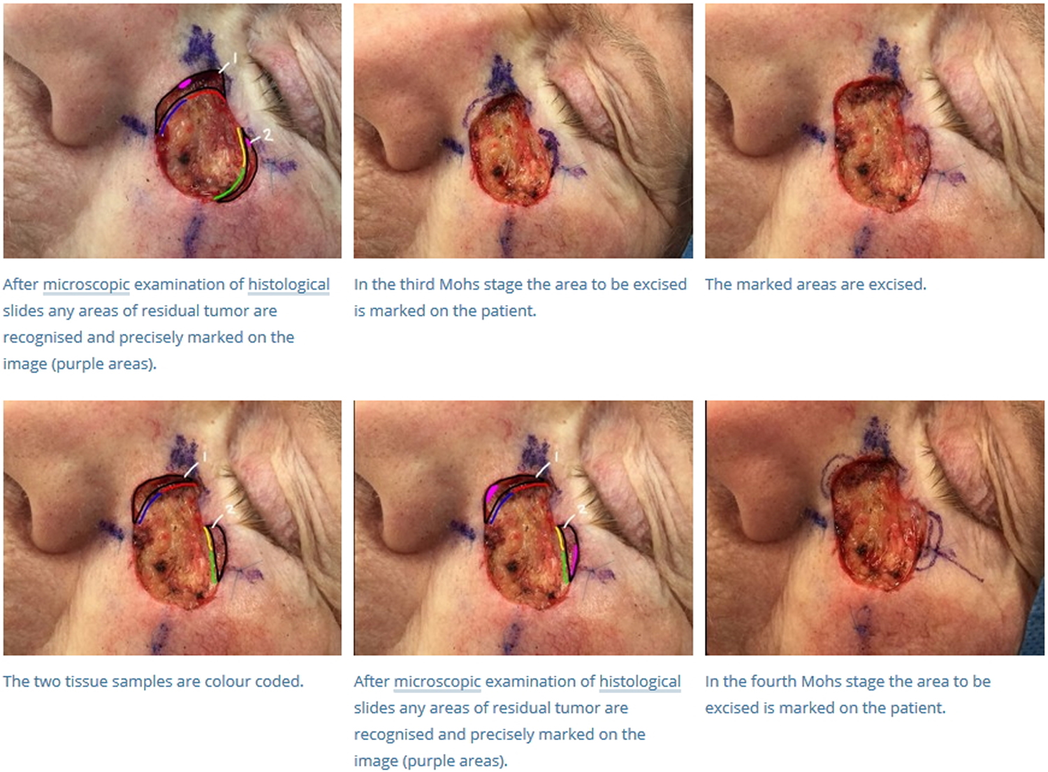 Mohs surgery for infiltrative basal cell carcinoma